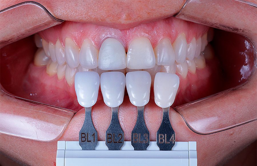 Sorriso com resultado estético de facetas em resina